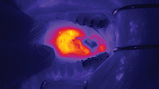 infrared image of a tumor