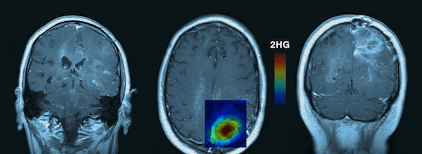 Time in a bottle: How UTSW paved the way for a breakthrough brain cancer drug