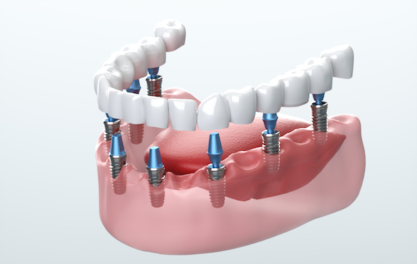 Dental implants: A 5-step plan to restore your teeth