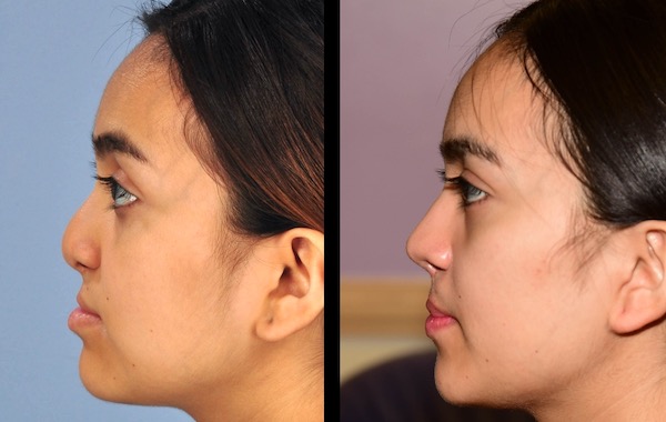 Cleft lip revision, rhinoplasty can restore confidence for teens and adults