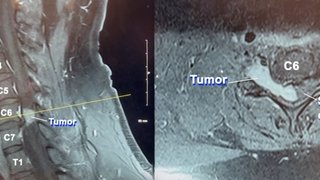 'Every day is a blessing': 11-hour surgery removes dangerous, rare spinal tumor - Featured image