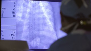 After heart attack, this rare procedure can save patients from a hole in the heart - Featured image
