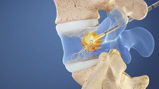 New Intracept procedure provides lasting relief for chronic low-back pain - Featured image
