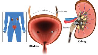 7 diet tips to prevent kidney stones - Featured image