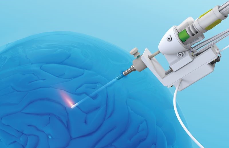 Laser surgery offers hope for patients living with epilepsy and brain cancer
