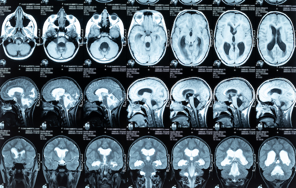 NPH: A misunderstood form of dementia that can be reversed