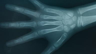 x-ray of hand