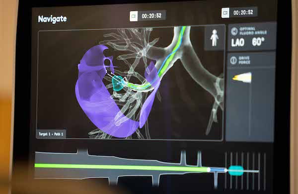 Robotic bronchoscopy offers minimally invasive, earlier lung cancer diagnosis