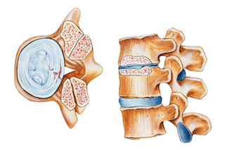 Get help for back, neck, and leg pain caused by spinal stenosis