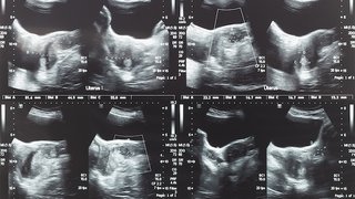 Can uterine fibroids harm my pregnancy?