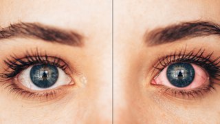 Understanding uveitis: A vision-threatening but treatable eye disease - Featured image