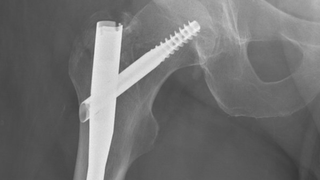 Why hip fractures require immediate treatment - Featured image